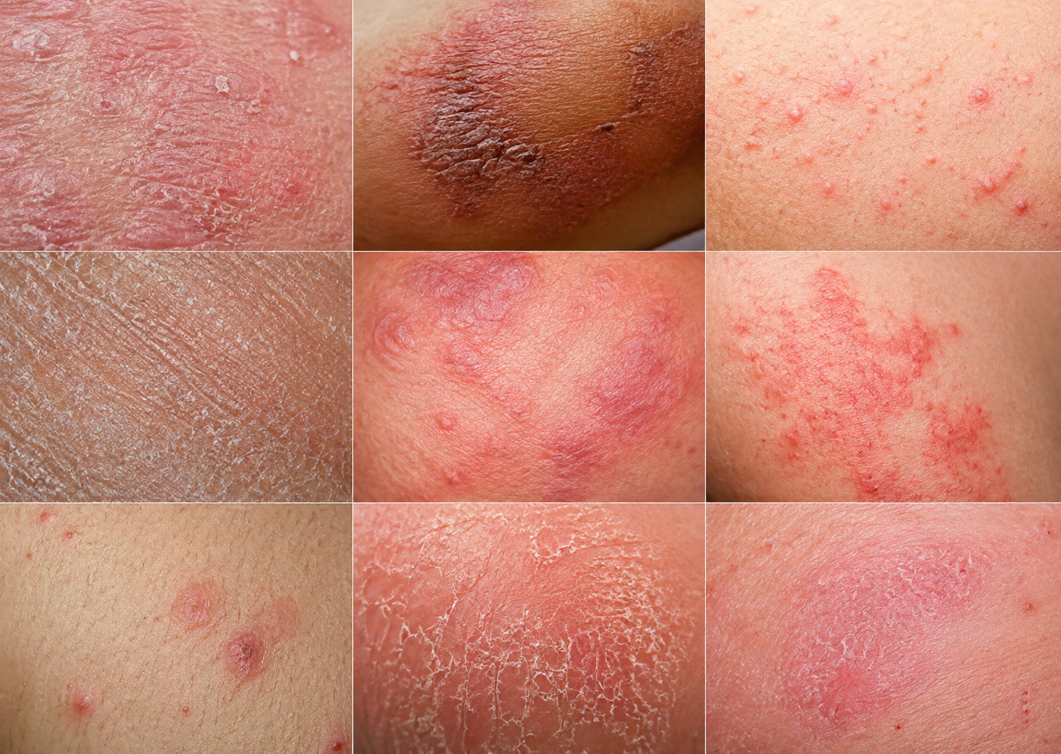Foto Eczema